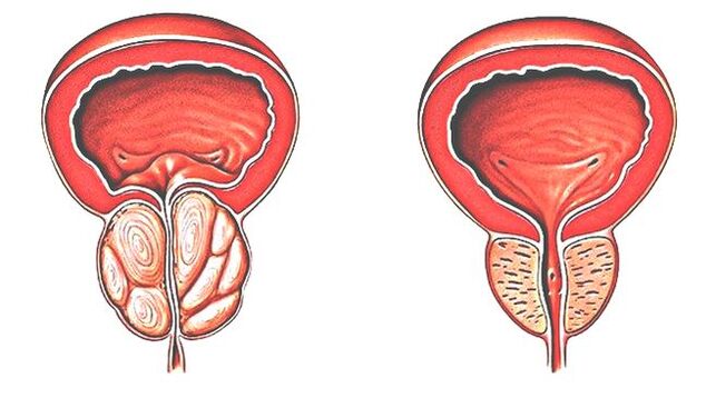 Prostatitis and normal prostate. 