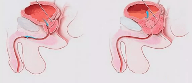 Men's prostatitis signs