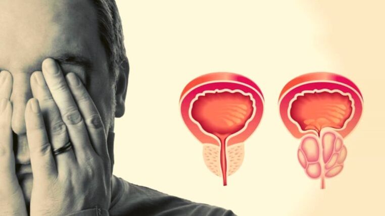 A man has prostatitis