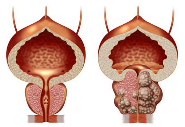 healthy prostate and prostate adenoma